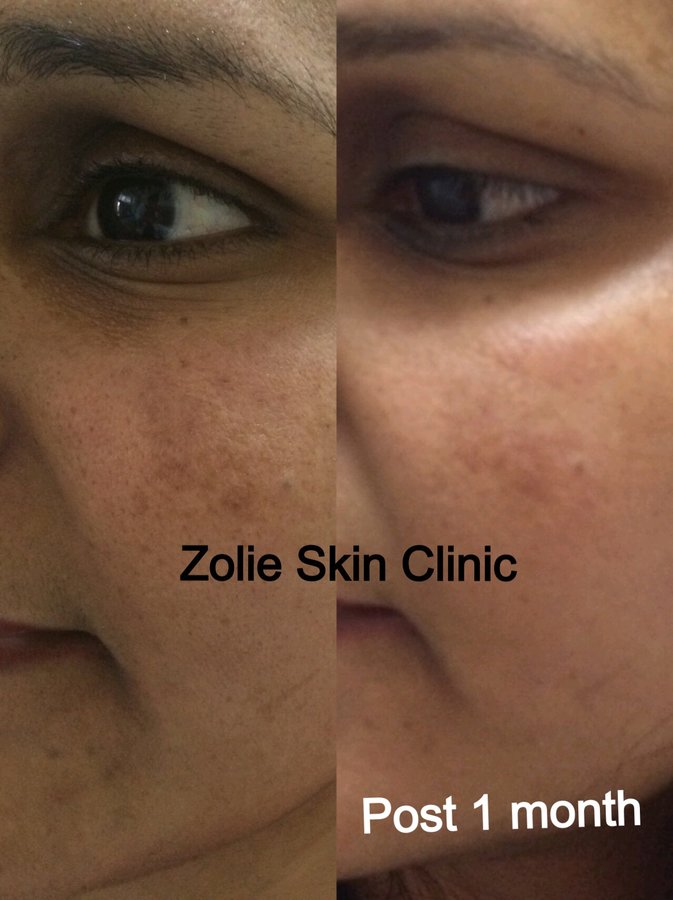 Zolie Skin Clinic - Guragaon - Dermatology Clinic in ...