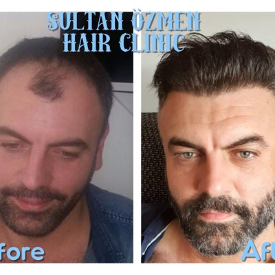 Sultan Özmen Hair Clinic