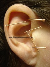 Auricular Acupuncture - Jayanth Acupuncture Clinic - Koyambedu