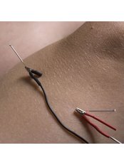 Electro-Acupuncture - JHS Acupuncture