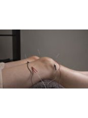 Electro-Acupuncture - Highgate Acupuncture Clinic