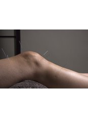 Dry Needling - Corinium Acupuncture