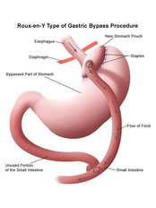 Gastric Bypass - The Health Clinic