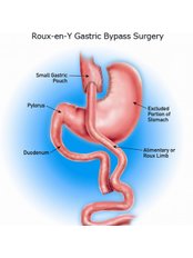 Gastric Bypass - Cirugía Especialilzada