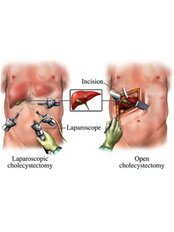 Gallbladder Removal - General Laparoscopic Surgeon