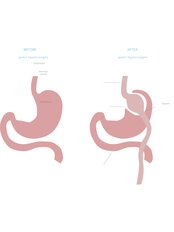 Gastric Bypass - Sanitus Clinic