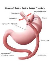 Gastric Bypass Surgery, Gastric Bypass Procedure, Gastric Bypass Surgeon, Gastric Bypass Center, Gastric Bypass Hospital, Gastric Bypass clinic - Mexicali Bariatric Center