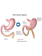 Gastric Bypass and Mini Bypass - CeMar Surgery - Top Bariatric Surgery Program