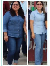 Gastric Bypass - Gastric Sleeve La Paz