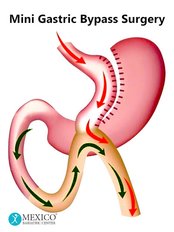 Mini Gastric Bypass - Mexico Bariatric Center