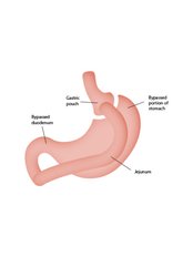 Gastric Bypass - Mexico Bariatric Center