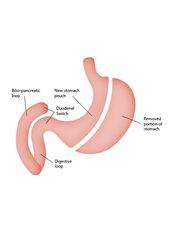 Duodenal Switch - Mexico Bariatric Center