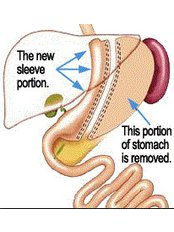 Gastric Sleeve  Sleeve Gastrectomy - Obesity Goodbye Center