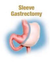 Gastric Sleeve - Philippine Obesity Control Surgery Team