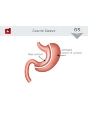 Gastric Sleeve - KCM Clinic Jelenia Gora