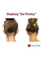 Ohrenkorrektur - KCM Clinic