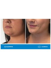Neck Liposuction - Allmedica