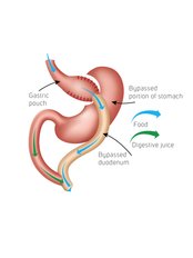 Gastric Bypass - KCM Clinic Wroclaw