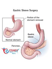 Gastric Sleeve - Esney Health Travel