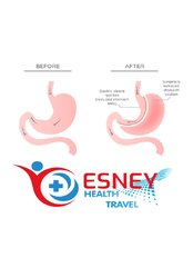 Revisional Bariatric Surgery - Esney Health Travel