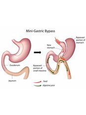 Gastric Bypass - Obesity Clinic Antalya - Dr. Suleyman Akilli