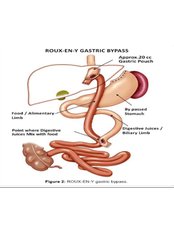 Gastric Bypass - Roux-En-Y Gastric Bypass (Stomach Bypass) - Klinik Mavi