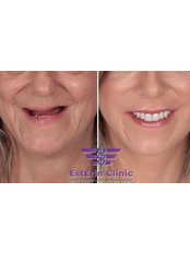 All-on-6 Dental Implants - Esterin Clinic