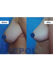 Breast Reduction - Egepol Hospitals
