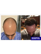 Hair Transplant - Egepol Hospitals