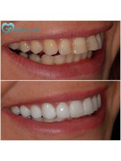 Dental Crowns - Gastro Life Assistance
