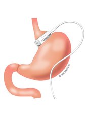 Gastric Band Fill - Gastric Band Fill & Epoque Aesthetics West Midlands & Southwest