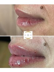 Lip Filler - Golden Aesthetic