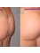 Centro Dr. Emiliano Alvarez - Butt Implants 