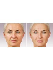 Dermal Fillers - Cosmetic Laser Clinic