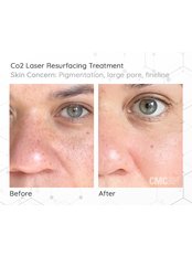 CO2 Fractional Skin Resurfacing - Cosmetic Medical Clinic (NSW)