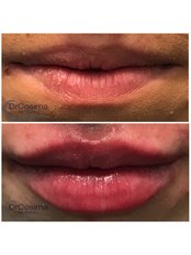 Lip Augmentation - Dr Cosima Medispa