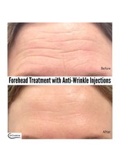 Forehead Treatment with Anti-wrinkle Injections - Dr Cosima Medispa