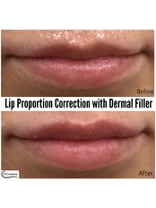 Lip Proportion Correction with Dermal Filler - Dr Cosima Medispa
