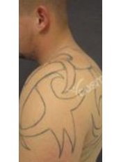 Tattoo Removal - Cosmedix Clinics