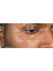 Scar Removal - Cosmedix Clinics