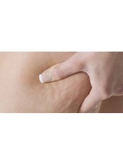 Cellulite Treatment - Natural Cosmetic Clinic