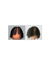 Treatment for Female Pattern Hair Loss - Victory BLC Therapy - Sydney