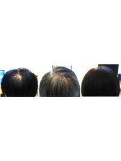 Hair Loss Treatment - Victory BLC Therapy - Sydney
