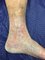 The Leg Vein Doctor - Venous Ulcer - post treatment 