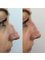 Injex Clinics - Non-surgical nose augmentation 