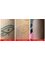 Rethink Laser Tattoo Removal - Shop 20, 137 Scottsdale Drive, Robina, Qld, 4226,  21