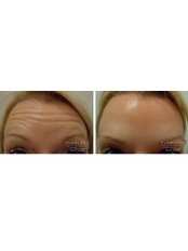 Treatment for Wrinkles - Flawless Rejuvenation Skin Clinic