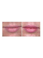 Lip Augmentation - Flawless Rejuvenation Skin Clinic