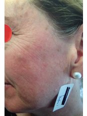 Facial Rejuvenation - Instant Laser Clinic
