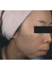 Acne Scars Treatment - Instant Laser Clinic